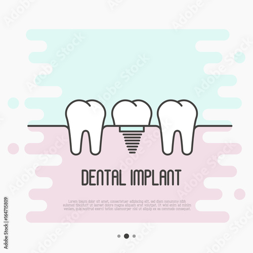 Dental implant concept: two healthy teeth and implant tooth between. Thin line vector illustration.