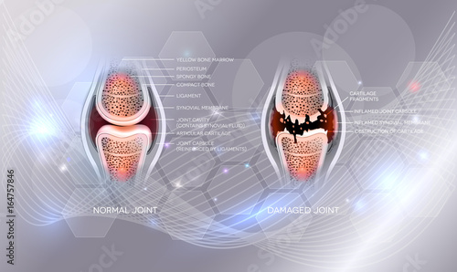 Damaged joint and normal joint design on an abstract grey glowing background
