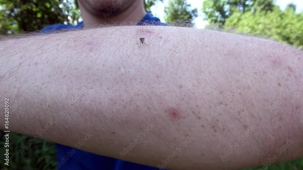 meine Mücke sitzt auf einem Arm und saugt Blut Stock ビデオ | Adobe Stock