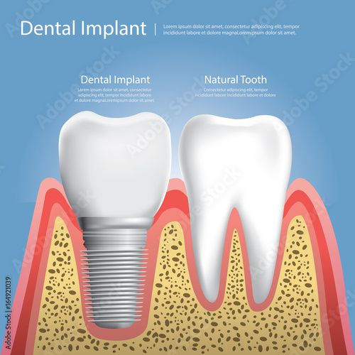 Human teeth and Dental implant Vector Illustration