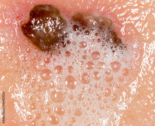 Wound on human skin in hydrogen peroxide