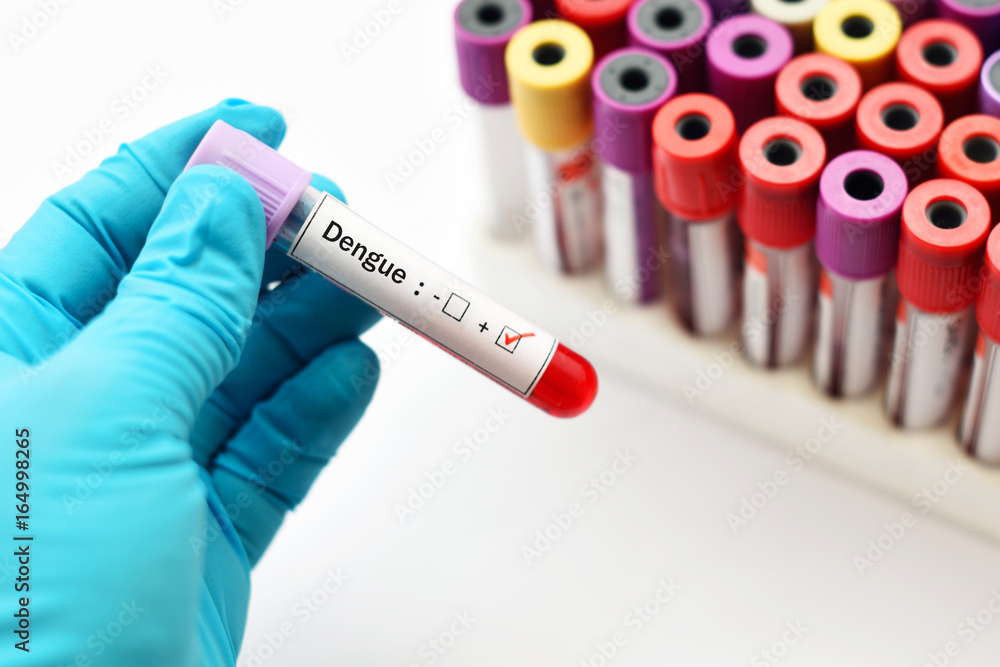 Fototapeta premium Blood sample positive with dengue virus test 