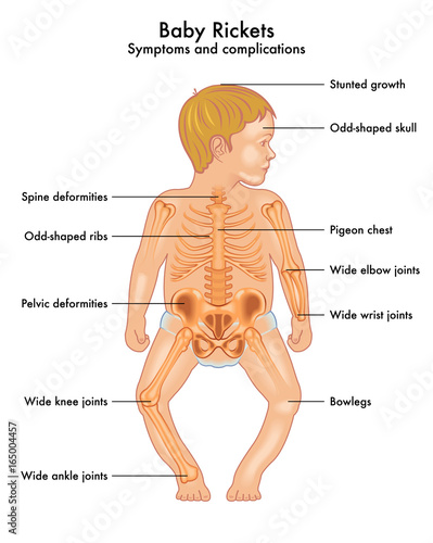 Baby Rickets