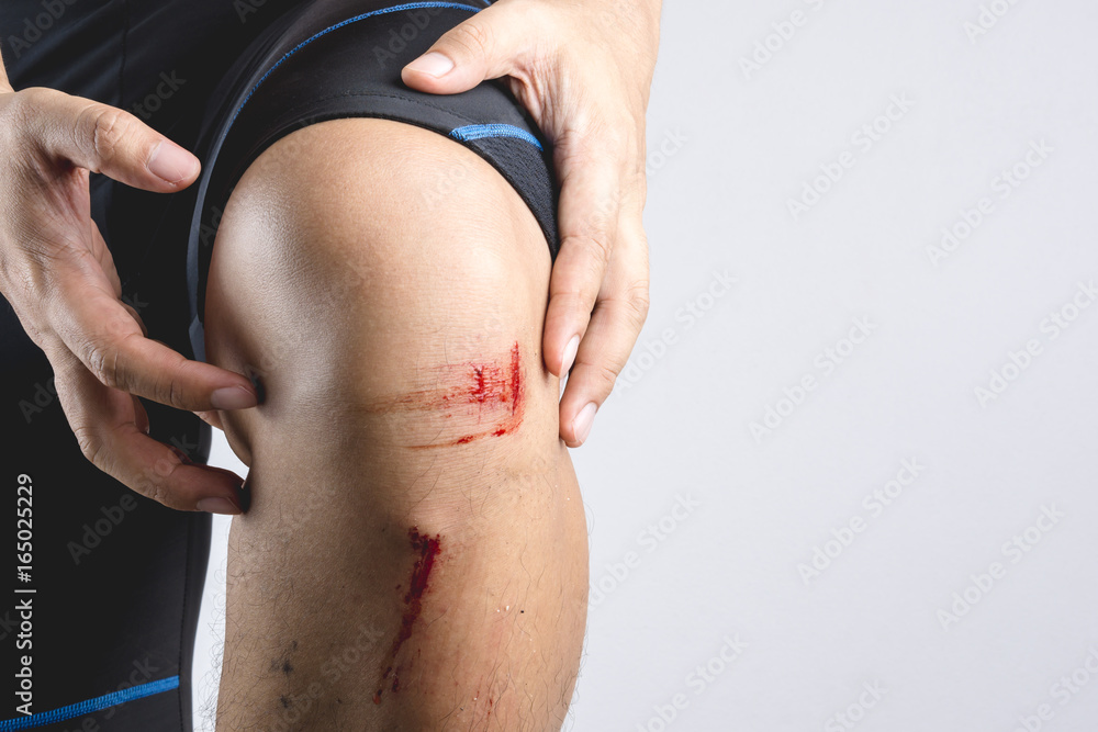 Naklejka premium Fresh bruise knee wound injury with some small stone and dust left from bike accident