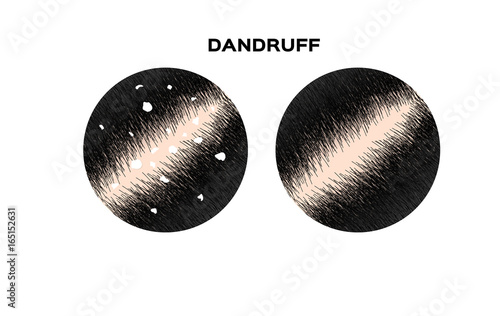 Dandruff on hair vector , closeup on skin