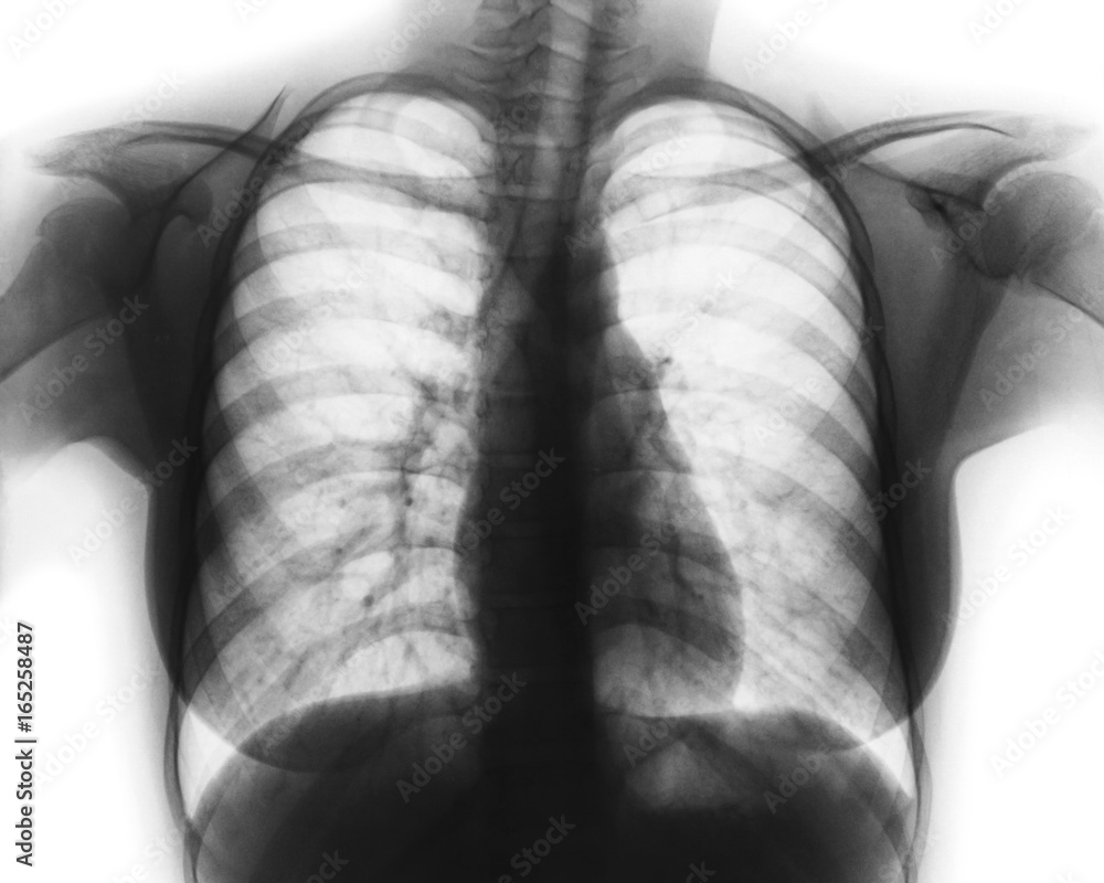 Film chest x-ray of normal woman chest Stock Photo | Adobe Stock