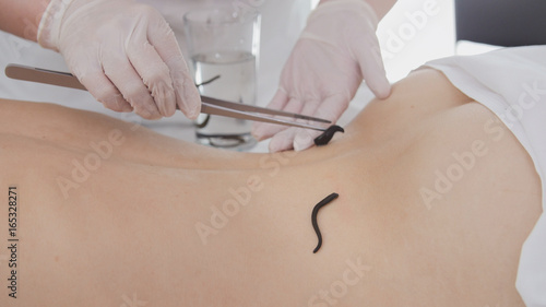 Doctor doing procedure of hirudotherapy for blonde young woman photo