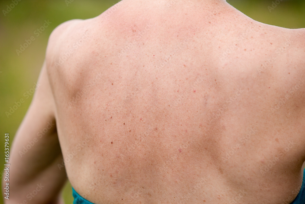 Women with skin pigmentation on back Women with skin pigmentation on back