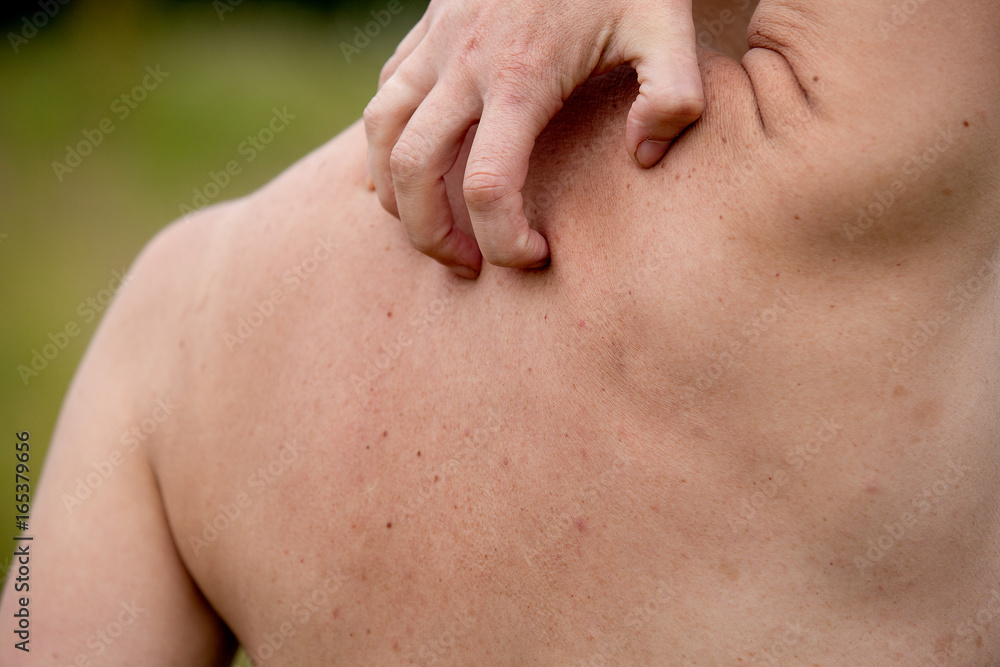 Naklejka premium Women with skin pigmentation on back