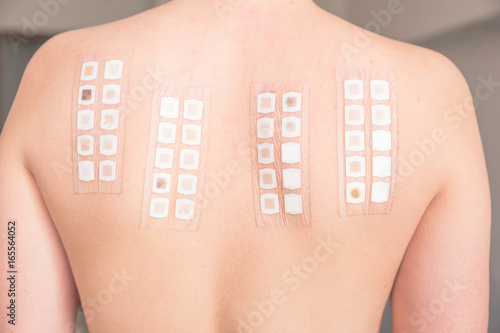 Alergy patch test on the back of a young woman