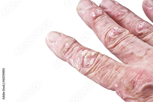 Psoriasis, skin disease on the joints of the body