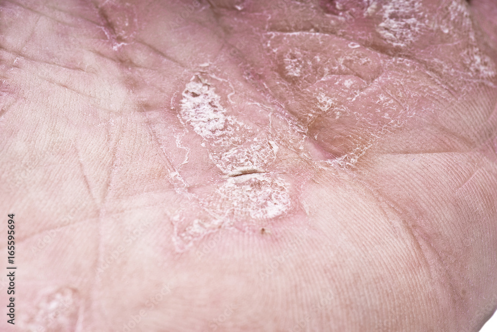 Fototapeta premium Psoriasis, skin disease on the joints of the body