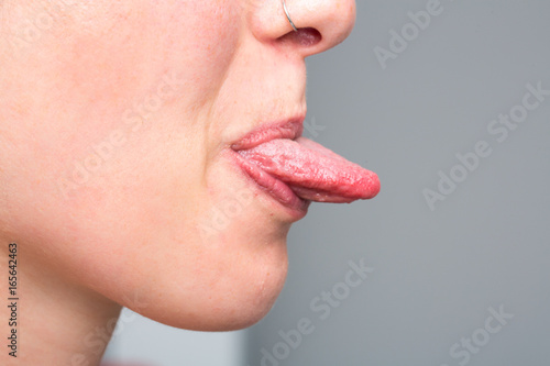 Young girl showing her tongue after candidiasis treatment
