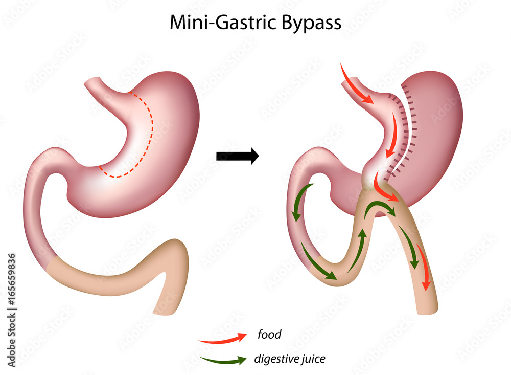 Φωτογραφία Mini gastric bypass, non-labeled