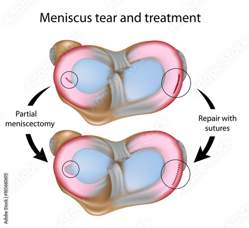 Meniscus tear and surgery treatment photo