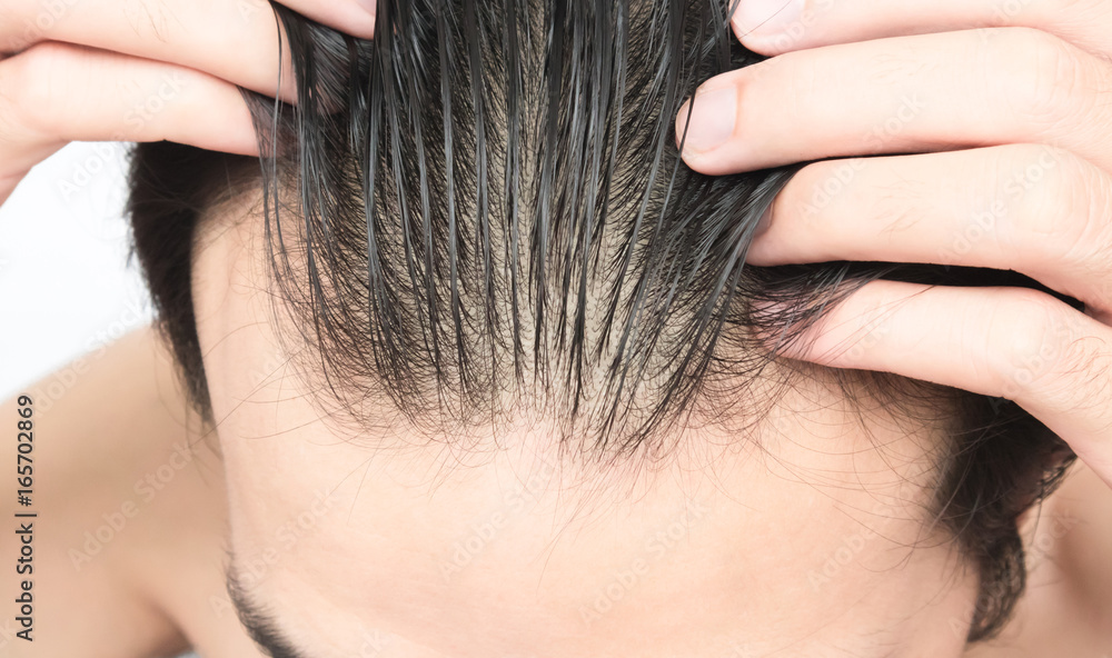 Young man serious hair loss problem for health care shampoo and beauty product concept Young man serious hair loss problem for health care shampoo and beauty product concept