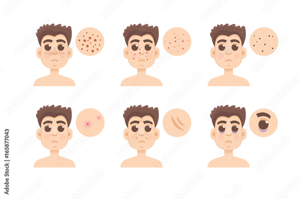 Men skin problem. Acne men. Vector illustration. Men skin problem. Acne men. Vector illustration.