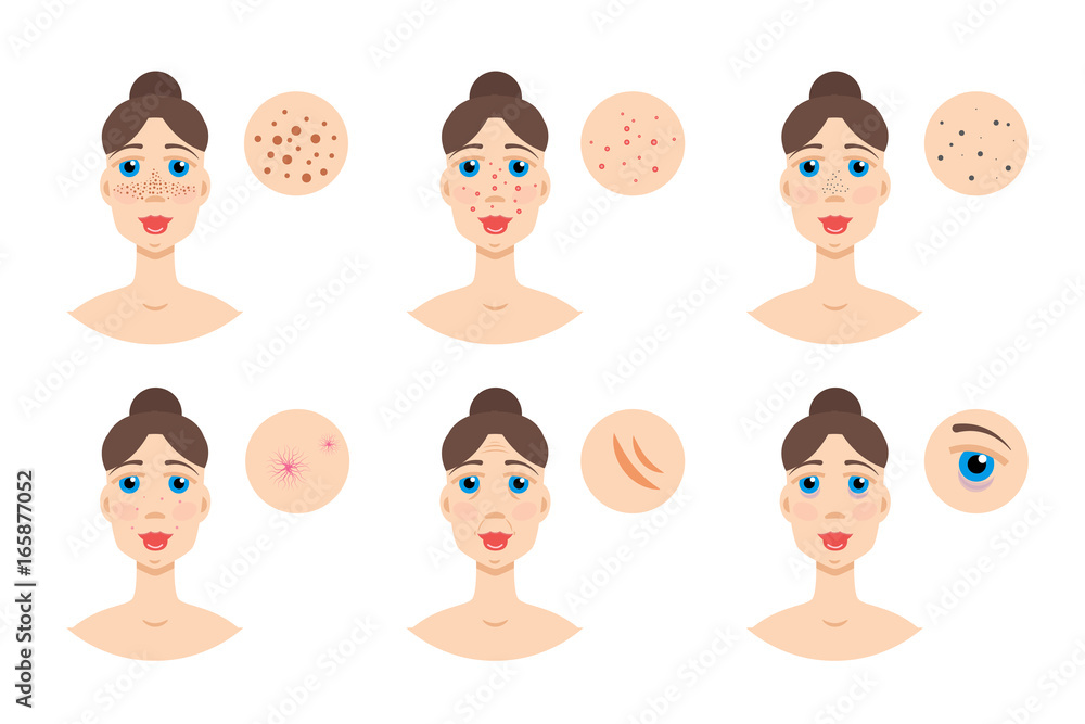 Woman with skin problem, acne. Vector illustration Woman with skin problem, acne. Vector illustration