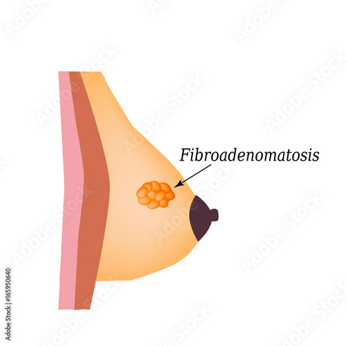 1235431 Fibrooadenomatosis in the mammary gland. World Breast Cancer Day. Vector illustration on isolated background