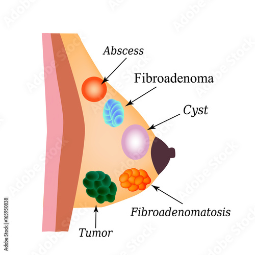 Fibroadenomatosis, Fibroadenoma, Abscess, Tumor, Cyst in the mammary gland. World Breast Cancer Day. Vector illustration on isolated background