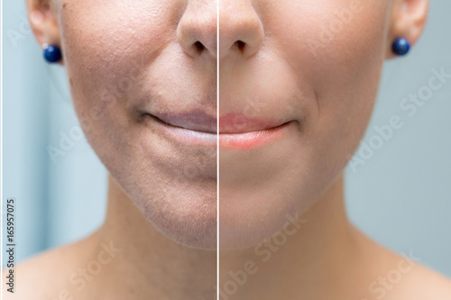 Woman face before and after cosmetic treatment