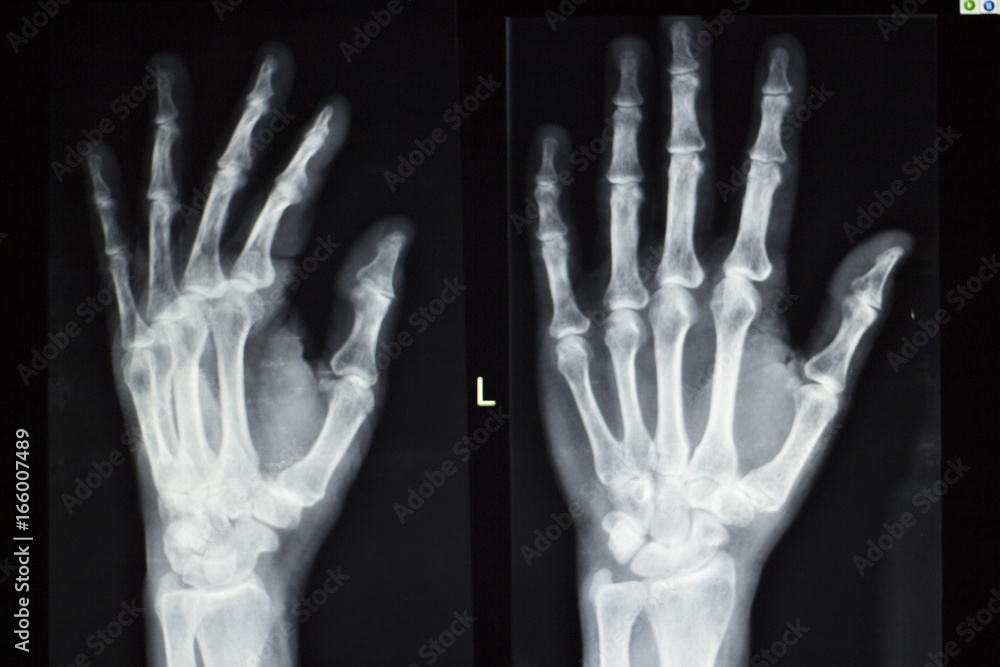 Hand fingers xray test scan Hand fingers xray test scan