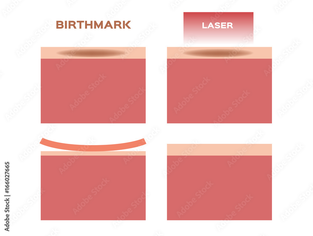 laser remove the birthmark vector