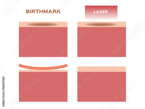 laser remove the birthmark vector