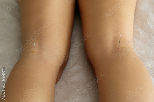 Female legs with steel needles during procedure of acupuncture therapy