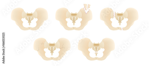 pelvis bone crack vector