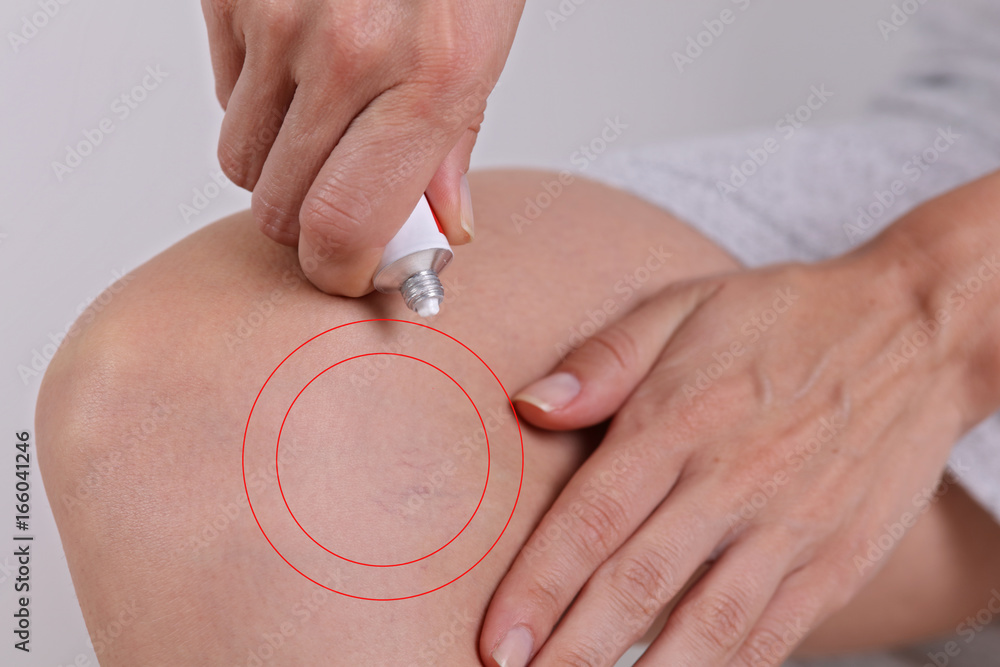 Fototapeta premium Woman appying Varicose Vein Cream close up