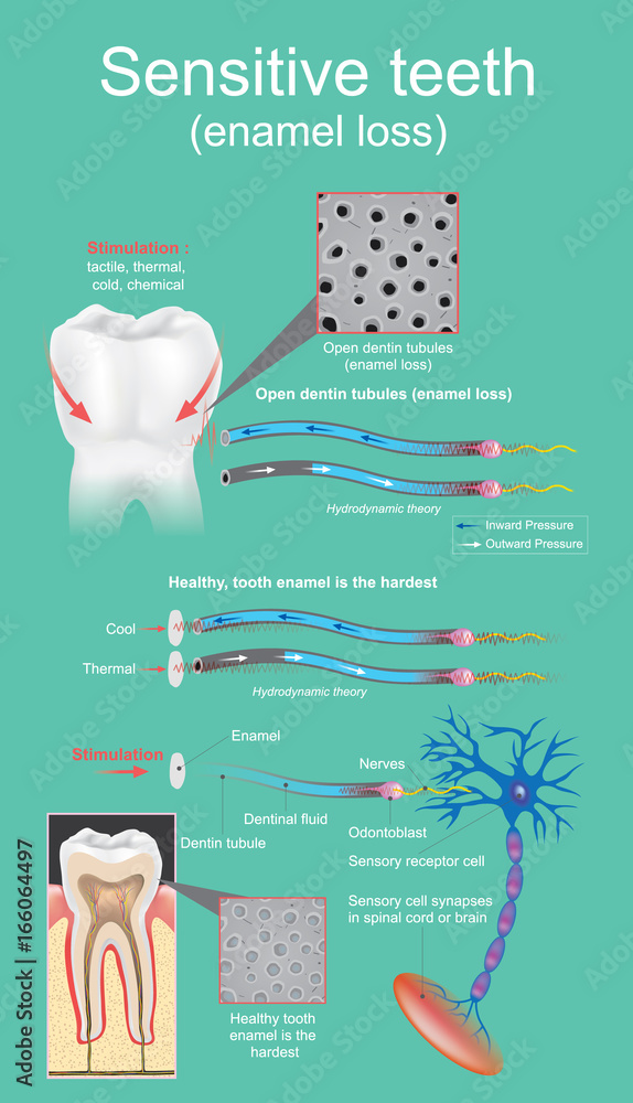 Sensitive dental is defined as intense and transitory pain that is