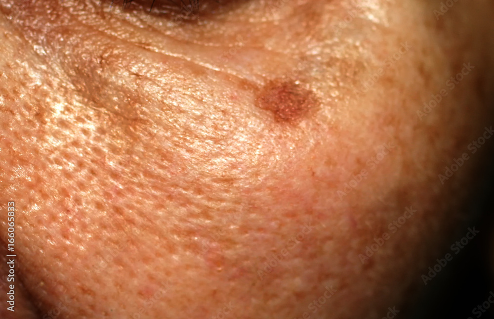 Fototapeta premium 1237980 Brown stain on the face. Pigmentation on the skin