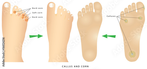 Corns and calluses