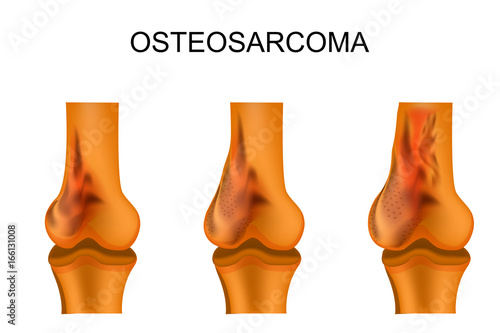 the thigh bone affected by osteosarcoma photo