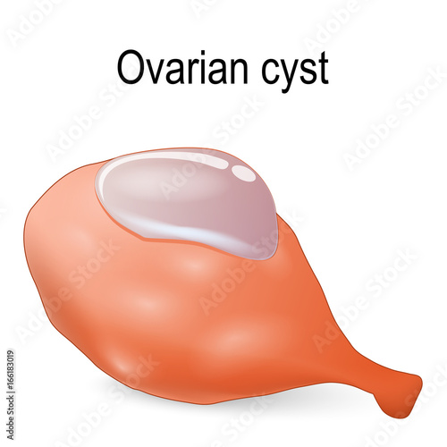 Ovarian cyst