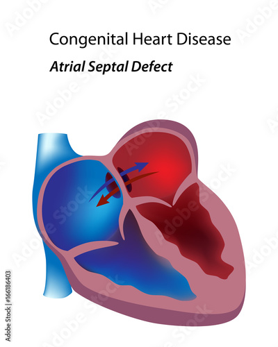 Foto Congenital heart disease: atrial septal defect