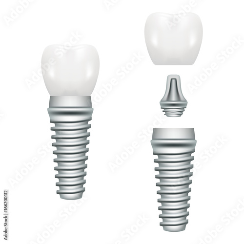 Realistic Dental Implant Structure With All Parts Crown, Abutment, Screw Isolated On A White Background. Vector Illustration. Stomatology. Creative Medical Concept
