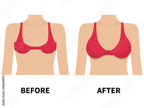 Female breast before and after plastic surgery photo