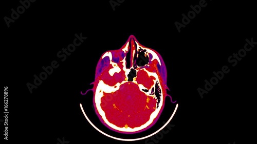 Magnetic Resonance Imaging of the Brain - CT Scan