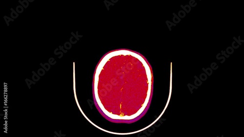 Magnetic Resonance Imaging of the Brain - CT Scan