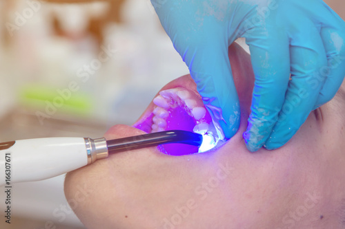 Dentist working with dental polymerization Lamp in oral cavity.