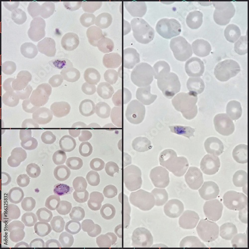 Three human parasite form patterns, trophozoite form of Plasmodium malariae malaria infected red blood cells on thin film blood smear under 100X light microscope (Selective focus). photo