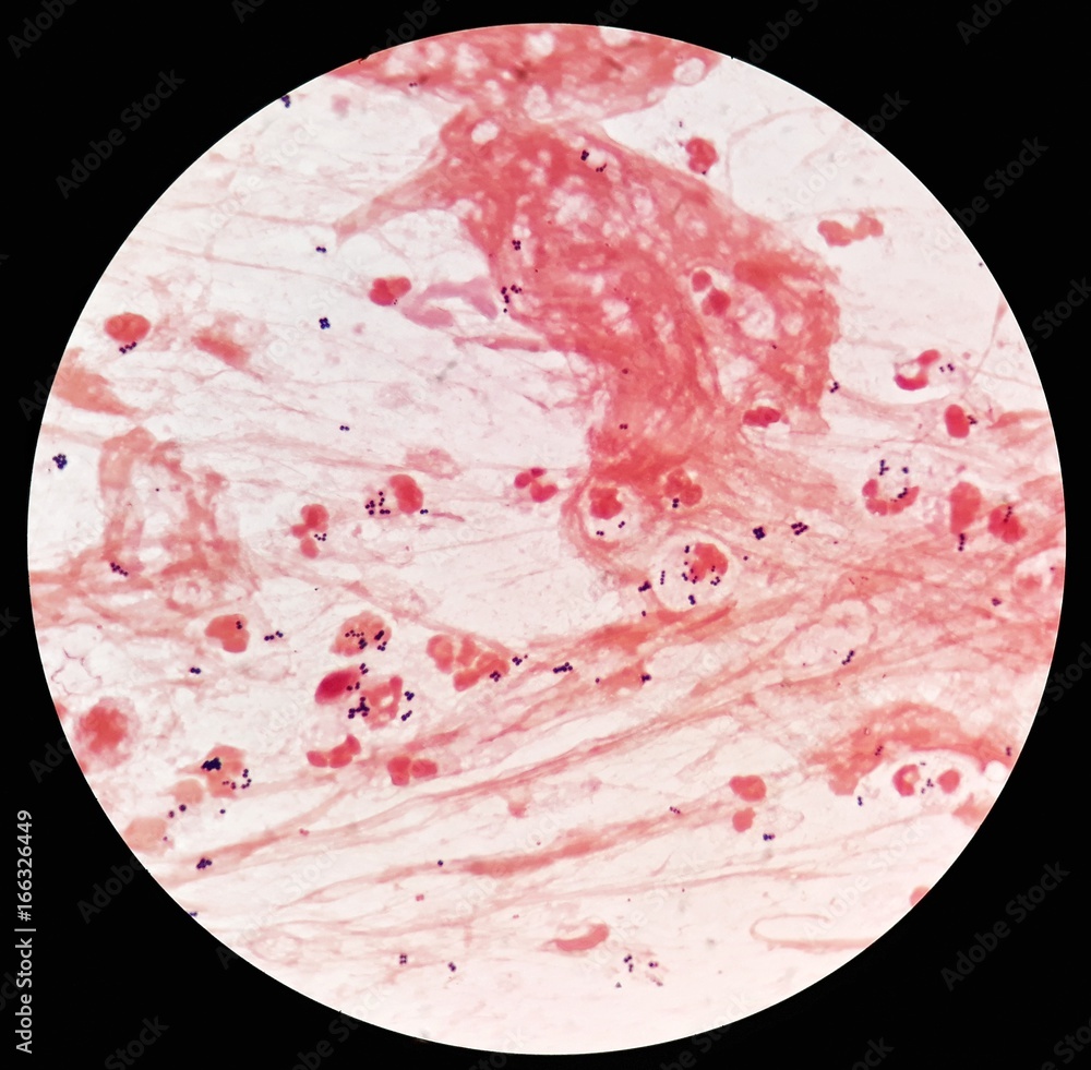 Smear of sputum specimen Gram's stained under 100X light microscope