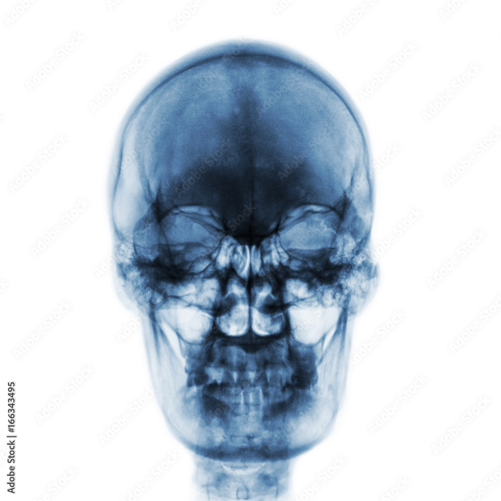 Obraz premium Film x-ray of normal human skull on isolated background . Front view