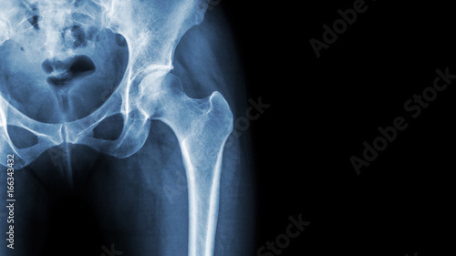 Photo X-ray normal pelvis and hip joint . Blank area at right side