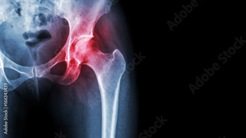 Arthritis at hip joint . Film x-ray show inflamed of hip joint and blank area at right side . Avascular necrosis concept photo