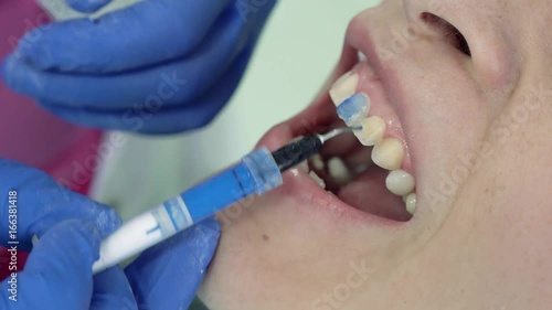 Dentist puts base for placing dental veneers