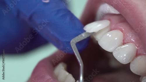 Dentist puts dental veneers patient and correction of teeth photo