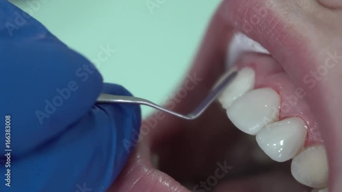 Dentist puts dental veneers patient and correction of teeth